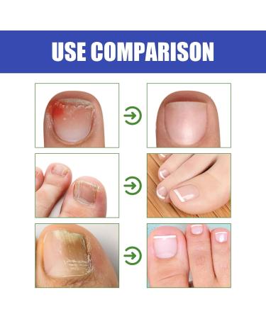 Raevior Nail Care Solution 10ml repairs and strengthens damaged nails improves discoloration softens thickened nails gentle daily care for hands and feet (6 PCS) - Buy Online on GoSupps.com
