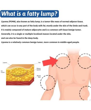 Lipoma Removal Cream Lipoma Elimination Cream Natural Herbal Lipoma Soothing Cream Effective Lipoma Care Cream Cream Relieve Varicose Veins Instant Tumor Removal Cream Skin Anti Swelling Cream - Buy Online on GoSupps.com