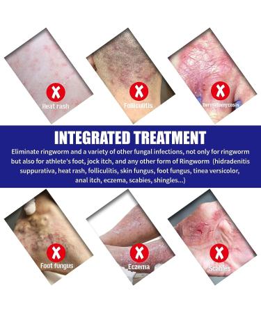 Foot Rash Cream for Itchy Feet Relief - Jock Itch, Ringworm, Psoriasis, Eczema, Athlete's Foot Treatment - Natural 4 Fl Oz - Buy Online on GoSupps.com