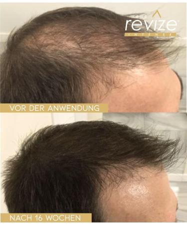REVIZE Men Foam - Hair Growth Stimulator | Thicker & Fuller Hair | 3-Month Supply with Biotin (3 X 60ml) - Buy Online on GoSupps.com