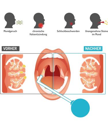 Fuchsia Tonsil Stones Remover | Effective Tonsil Suction Cup for Stone Removal & Bad Breath Relief | Glass Cupping Solution - Buy Online on GoSupps.com