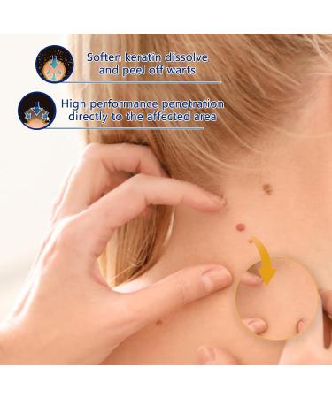  MagiSel Resistant Warts for Hands & Feet Anti-Wart and Anti-Stain Cream Anti-Wart Moisturizing Cream Anti-Corn Foot Descaling Wart Remover for Hands and Feet 20g - Buy Online on GoSupps.com