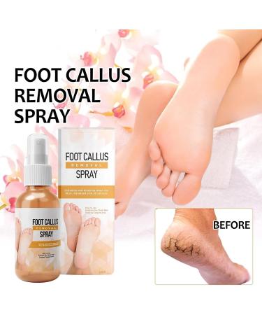 Tongyend Foot Peeling Spray Instant Foot Peeling Spray Foot Callus Removal Spray Moisturizing Hydrating Nourish Peel off Spray Foot Exfoliating Spray Remove Foot Dead Skin-30ML FootCallusRemover - Buy Online on GoSupps.com