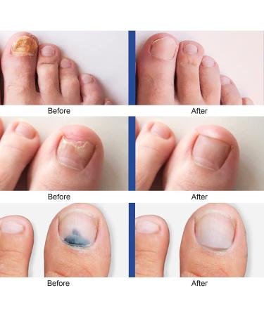 Nail Fungus Laser Treatment Device - Onychomycosis Laser Nail Treatment - Effective | Safe Rechargeable Laser Treatment at Home for Unattractive Discolored Damaged Nails - Buy Online on GoSupps.com