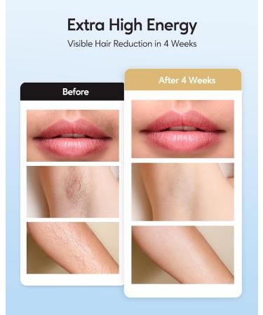 INNZA IPL Hair Removal Device for Women - 999 999 Flashes Ice Cooling Care Painless Permanent Hair Removal for Armpits Legs Arms & Bikini Line - Shop Internationally - Buy Online on GoSupps.com