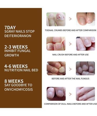 ATTDX NailGrowth DeepHealing Organic Serum NailGrowth Nail Serum Reconstrux Nail Growth Nail Growth and Strengthening Serum Nail Serum for Growth and Repair for Damaged Nails (1PC) - Buy Online on GoSupps.com