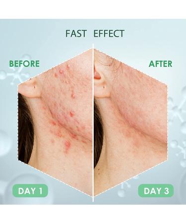 AUSLKA Pimple Patch (9 Patches) - Hydrocolloid Zit Patches for Face - Blemish & Acne Treatment Stickers - Buy Online on GoSupps.com