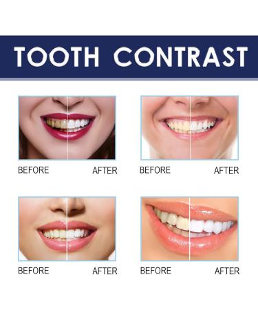 Teeth Whitening Pen - Pain-Free Tooth Bleaching Travel Size (5pc) | Quick & Gentle Tooth Whitening - Buy Online on GoSupps.com