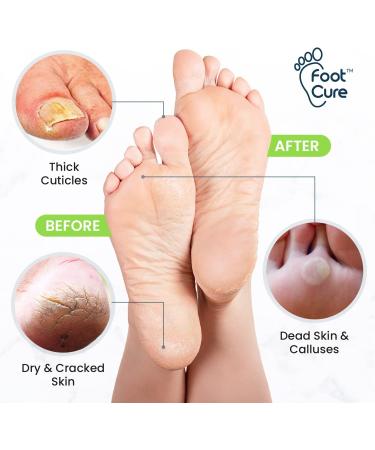 Foot Cure Exfoliator & Callus Remover Pedicure Set - Includes Foot File, Tea Tree Oil Soak, Urea Cream, USA Made - Buy Online on GoSupps.com