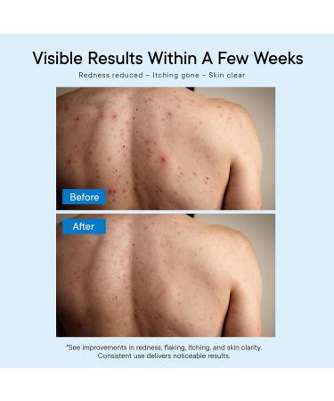 Antifungal Body Wash Treatment Soap Antibacterial Wash for Jock Itch Ringworm Back Acne Tinea & Foot Odor Medicated Skin Relief Cleanser Gel with Tea Tree Oil & Tolnaftate for Men and Women 1 - Buy Online on GoSupps.com