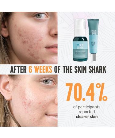 The Skin Shark Breakout Clearing Serum (50ml) - Hydrating Facial Serum With 5Beta-Scymnol For Blemish Prone Skin - Controls Facial Skin Oils that may be the cause of Acne - Suitable For Sensitive Skin - Buy Online on GoSupps.com