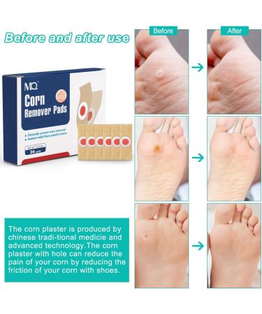 72 Corn Remover Pads - Effective Treatment for Stubborn Chicken Eyes & Corns - International Shipping - Buy Online on GoSupps.com