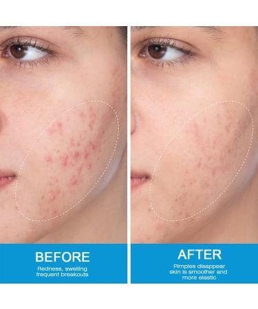  MagiSel Facial cream for acne-prone skin plant-based anti-blemish cream 20g moisturizing face cream hydrates and leaves skin feeling smooth gentle formula - Buy Online on GoSupps.com