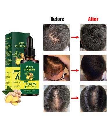 Ginger Hair Growth Germinal Oil 30ML (3pcs) - Regrow Hair in 7 Days | Nourishing Serum for Hair Roots - Buy Online on GoSupps.com