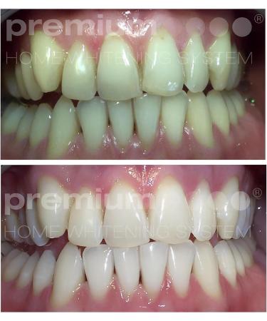 Premium Home Teeth Whitening Kit - Fast Safe & Effective Results | International Shipping Available - Buy Online on GoSupps.com