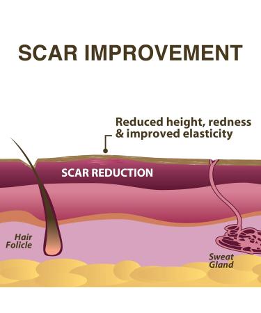Epi-Derm Large Silicone Scar Sheet - 11 x 15.75 in - Natural - Biodermis - Buy Online on GoSupps.com