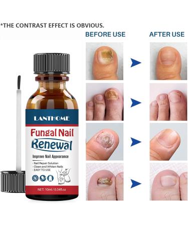 Fungal Nail Treatment - Toenail Treatment Extra Strong Nail Repair - Premium Fungal Nail Eliminator - Anti fungus Nail Repair and Strengthen Fix & Renew Damaged Broken Nails - Buy Online on GoSupps.com
