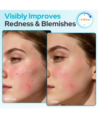 +1HEROLABS Acne Care Bundle: Hydrocolloid Pimple Patch for Deep Early and Hidden Blemishes + 2% Salicylic Acid Gel Serum for Pores & Oil - Buy Online on GoSupps.com