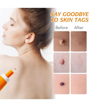 Easy to Use Skin Tag Tool Kit 2 in 1 Safe Skin Tags Skin Tag Tool Kit for (2-8mm) Skin Tags - Buy Online on GoSupps.com