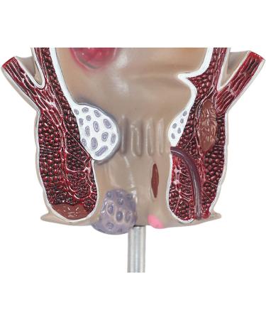 Medical Science Rectum Fissure Lesion Model 5X Human Pathology Model Hemorrhoid Anal Fistula Medical Organ Model - Buy Online on GoSupps.com
