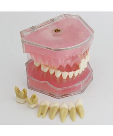 Dental Implant Teeth Model - Standard Study and Teaching Tool with Removable Teeth - Buy Online on GoSupps.com