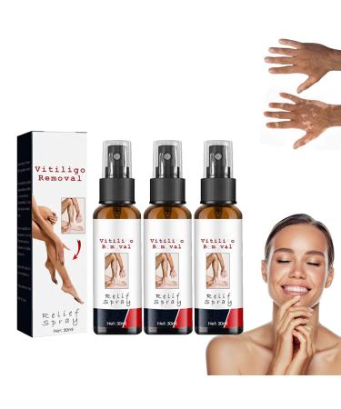 Barbas & Zac ri Vitiligo Removal Relief Spray Vitiligo Skin Repair Spray Vitiligo Treatment Spray Vitiligo Care Spray for Skin Care (3Pcs)
