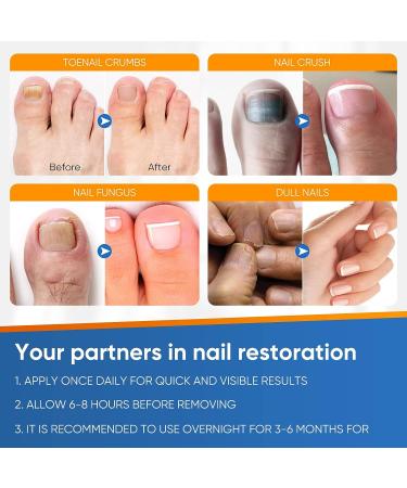 32Pcs Nail Repair Patches - Toenail Fungus Treatment for Damaged Nails - Buy Online on GoSupps.com