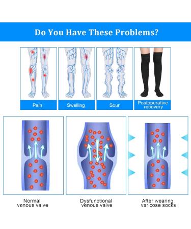 ACWOO Thigh High Compression Stockings 15-21mmHg - Support for Varicose Veins, Edema, Flight, Nurses, Running - Men & Women - Buy Online on GoSupps.com