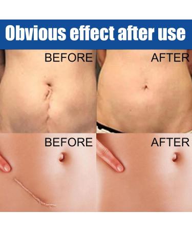 Nictules Body Scar Gel Burn Repair Balm skin05 fl Oz Scar Gel for Keloids and Hypertrophic Scars Reduces Appearance of Bruises MoisturizeNiktule - Buy Online on GoSupps.com