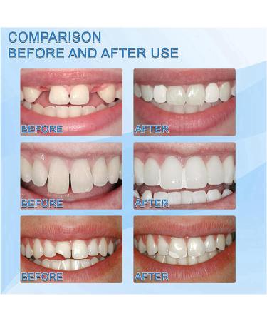 DIY Temporary Tooth Filling Kit for Missing or Broken Teeth - Moldable False Teeth Beads (2pcs) - Buy Online on GoSupps.com
