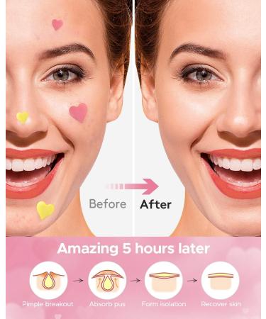 Pimple Patch Heart Shape 112 Hydrocolloid Acne Patches with Tea Tree Oil & Salicylic Acid (Pink & Yellow) - LitBear Spot Patche for Face - Zit Spot Sticker - 14mm & 10mm - Buy Online on GoSupps.com