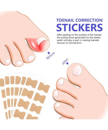 Ingrown Toenail Correction Patch - 100PCS Ingrown Toenail Sticker Breathable Toenail Corrector Patch Professional Ingrown Toenail Tool Painless Pedicure for Ingrown Toenail - Buy Online on GoSupps.com