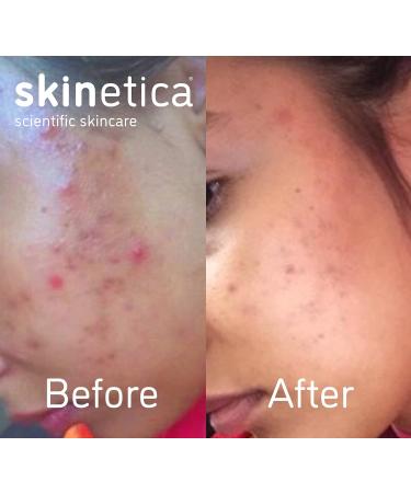 Skinetica Quintessence Face Toner 100ml - Acne & Blemish Treatment | Paraben-Free & Vegan | Gentle & Refreshing Formula for Sensitive Skin - Buy Online on GoSupps.com