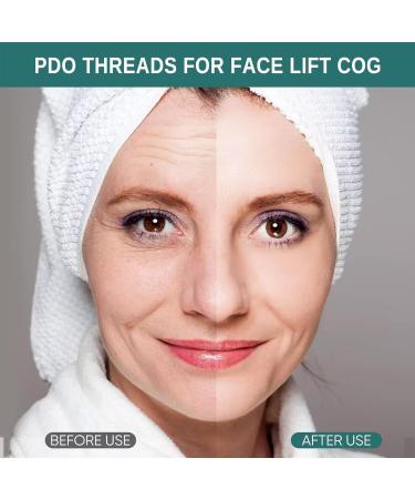  MITHCO Oldream PDO 20-Pack PDO 18G100mm Gears for Lifting PDO for Lifting Effective Firming of Sagging Skin - Buy Online on GoSupps.com