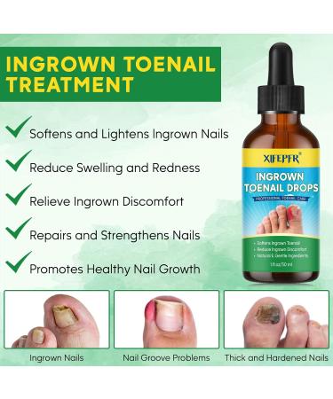 Ingrown Toenail Tools Kit - Stainless Steel Treatment & Corrector for Pain Relief | Pedicure Essentials - Buy Online on GoSupps.com