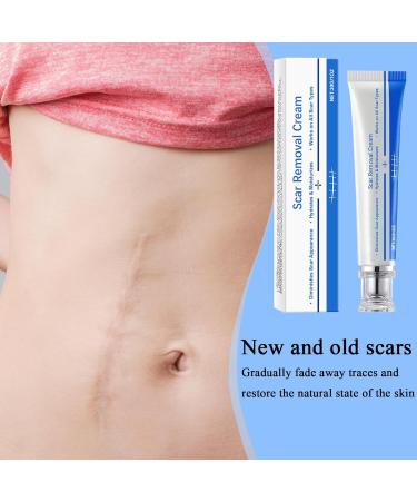 Scar Removal Stretch Mark Remover 30g Gel Reduces Stretch Marks Keloids Surgical Wounds Injuries Cesarean Section New and Old Scars - Buy Online on GoSupps.com