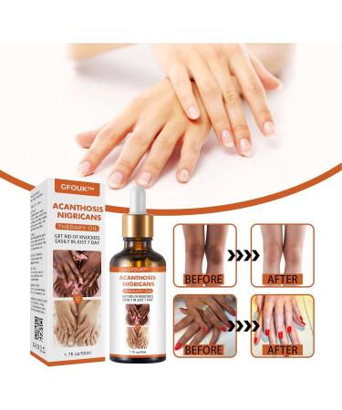 Skin Bleaching Serums | Dark Skin Permanent Whitening Lightening | Armpit Bleaching Serums for Women Supercharged Face Serums Skin Lightening Bleaching Oil Black Spot Corrector Remover for Face 2Pcs - Buy Online on GoSupps.com