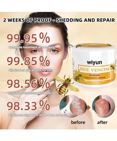 Cvreoz Bee Venom Psoriasis Cream | New Zealand Bee Venom Treatment for Psoriasis (1PC) - Fast International Shipping - Buy Online on GoSupps.com