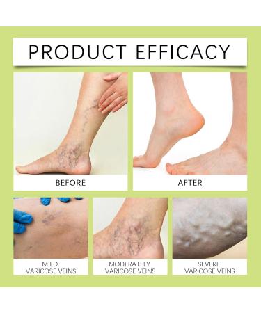 Baume apaisant et cicatrisant pour les jambes baume pour jambes enfl es baume miracle pour les veines r duit les gonflements soulage l'inconfort am liore les varices 2 Pi ces. - Buy Online on GoSupps.com