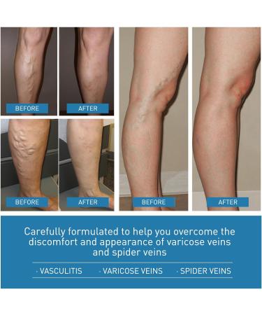 2pcs Varicose Veins Cream Varicose Veins Treatment for Legs Varicose Veins Relief Cream Spider Varicose Cream - Improve Blood Circulation Soothes Tired Legs 2 * 20g - Buy Online on GoSupps.com