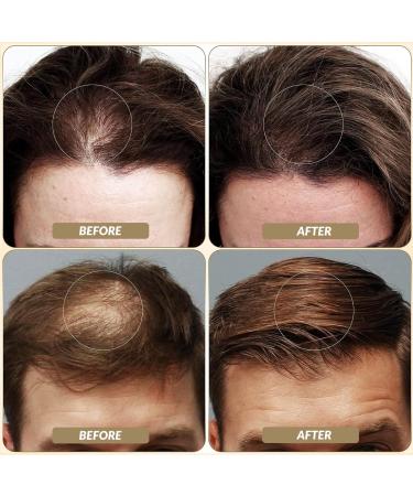 SOVONCARE Dark Brown Hair Fibers - Instant Thicker Hair for Men & Women | Conceal Thinning & Bald Spots - Natural & Undetectable 28g - Buy Online on GoSupps.com