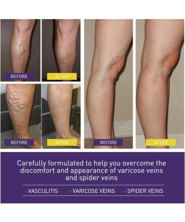 Varicose Veins Cream - Spider Veins Repair & Treatment for Legs | Relief Ointment - Buy Online on GoSupps.com
