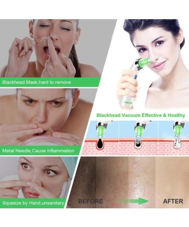 Pore Vacuum Blackhead Remover Cleanser | 5 Power Electric Extractor Tool for Women & Men | 4 Probes | Green - Buy Online on GoSupps.com