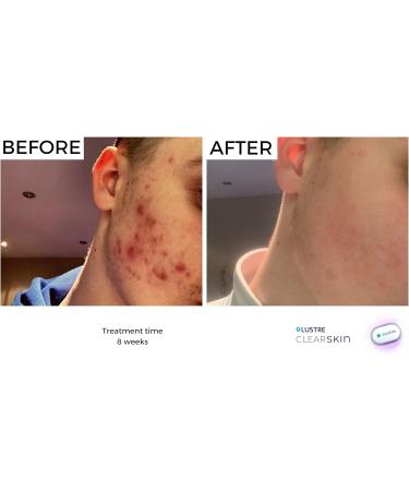 LUSTRE ClearSkin TRIO - Blue Light Acne Treatment Device UV-Free & Wireless | LED Therapy for Face and Body Acne Spots and Blemishes | Prevent breakouts inflammation and Skin Redness - Buy Online on GoSupps.com