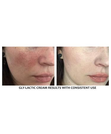 20% Gly-Lactic Exfoliating Cream - 10% Glycolic & 10% Lactic Acid for Face and Body (8 oz) - Buy Online on GoSupps.com