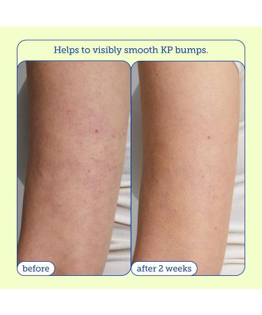 Skinfix KP+ Psoriasis Smoothing Treatment Body Lotion 5.07 oz | Soothes & Hydrates Skin - International Shipping Available - Buy Online on GoSupps.com