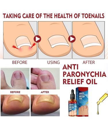 2Pcs German Toenailplus Anti Paronychia Relief Oil - Ingrown Toenail Treatment & Pain Relief for Damaged Thick Nails - Buy Online on GoSupps.com