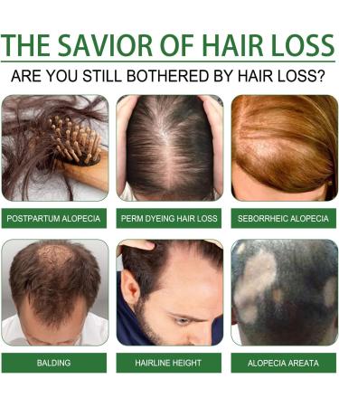 Rosemary Oil for Hair Growth Rosemary Hair Oil Rosemary Essential Oil for Hair Growth Wild Growth Hair Oil Improve Hair Loss and Nourishes Rosemary Scalp Oil for Women (60ML+2brush) - Buy Online on GoSupps.com