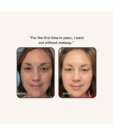 Barefaced Brightening Serum Dark Spot Corrector | Kojic Acid Arbutin Azelaic Acid & Licorice | Anti-Aging Hydrating | Antioxidant-Powered Formula Fades Hyperpigmentation & Evens Skin Tone (1 Oz) - Buy Online on GoSupps.com