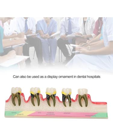 Dental Periodontitis Model | Periodontal Development Study Tool for Dental Research & Learning - Buy Online on GoSupps.com